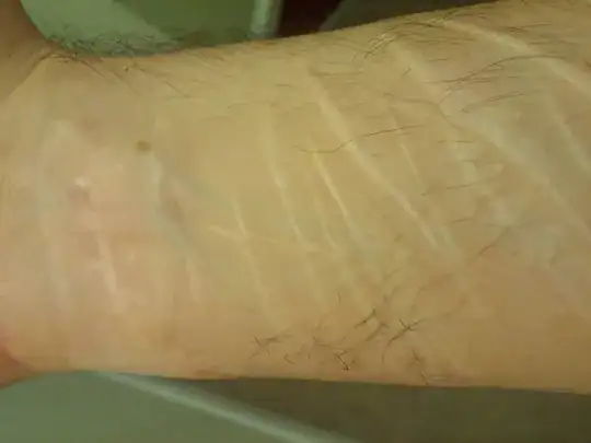 scarring