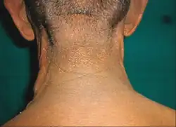 AN in bladder cancer