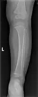 Accidental or innocent toddler fracture/frontal