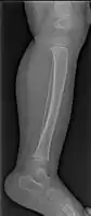 Accidental or innocent toddler fracture/lateral