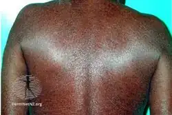 Ichthyosis acquisita
