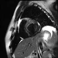 Acute anteroseptal myocardial infarction