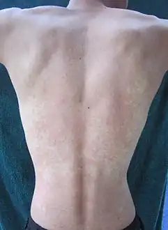 The back of an East Asian man showing alcohol flush reaction.