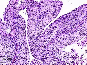 Histopathology of urothelial carcinoma of the urinary bladder. Transurethral biopsy. H&E stain