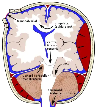 Types of brain herniation.