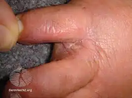 Dermatophytide