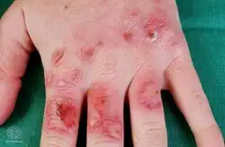 Chilblains