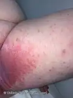 Irritant contact dermatitis