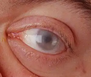 Corneal clouding in a 30-year-old male with MPS-VI. Several other MPS disorders may also present with corneal clouding