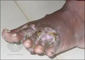 Mycetoma foot