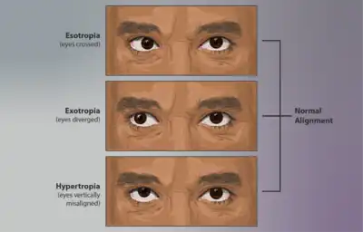 Strabismus is a condition where the eyes are not aligned correctly, also known as "crossed-eyes." It is a common facial symptom of SCARF.