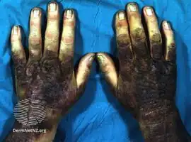 Coal tar/treatment