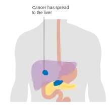 Metastasis – stage M1