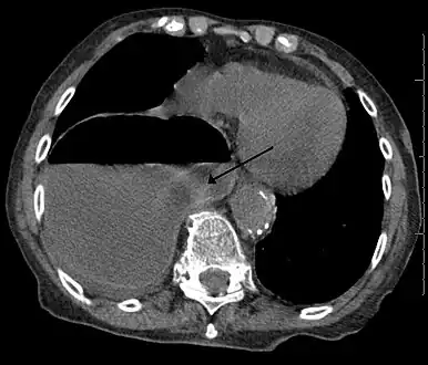 Congenital diaphragmatic hernia