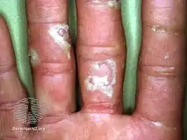 Keratolysis exfoliativa