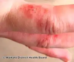Contact dermatitis-isocyanate