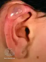Hydroa vacciniforme