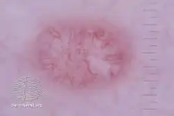 Molluscum contagiosum on dermoscopy