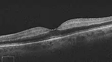 Ocular coherence tomogram (OCT) of a person with central retinal artery occlusion