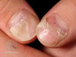 Onychomadesis following hand foot and mouth disease