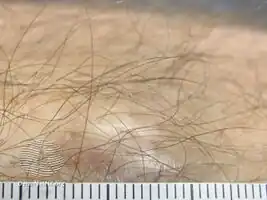 Osteoma cutis