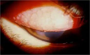 Keratoconjunctivitis