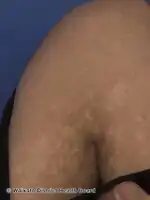 Postinflammatory hypopigmentation after recovery from dengue-like rash in a patient with suspected COVID19