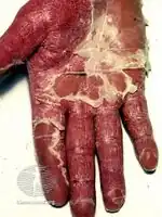 Erythroderma