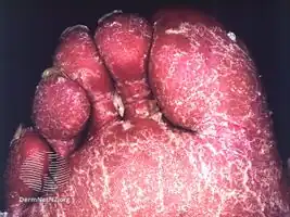 Erythroderma