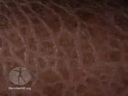 Ichthyosis