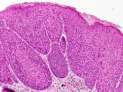 Bowenoid papulosis