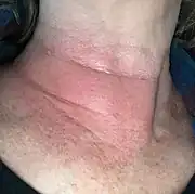 Erythema migrans ("redness migrating") and may have no definite pattern, as in this Lyme rash on a woman's neck. Rashes from non-Lyme causes may look similar.