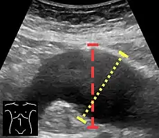 Ultrasonography in the sagittal plane, showing axial plane measure (dashed red line), as well as maximal diameter (dotted yellow line) which is preferred.