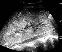 Kidney ultrasonograph in renal failure after surgery with increased cortical echogenicity and kidney size. Biopsy showed acute tubular necrosis.