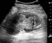 Kidney ultrasonograph in kidney trauma with laceration of the lower pole and subcapsular fluid collection below the kidney.