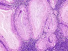 Histopathology of Warthin tumor in the parotid gland. Another view of Fig 1