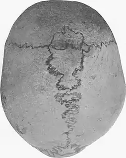 Sagittal suture with Wormian bones.